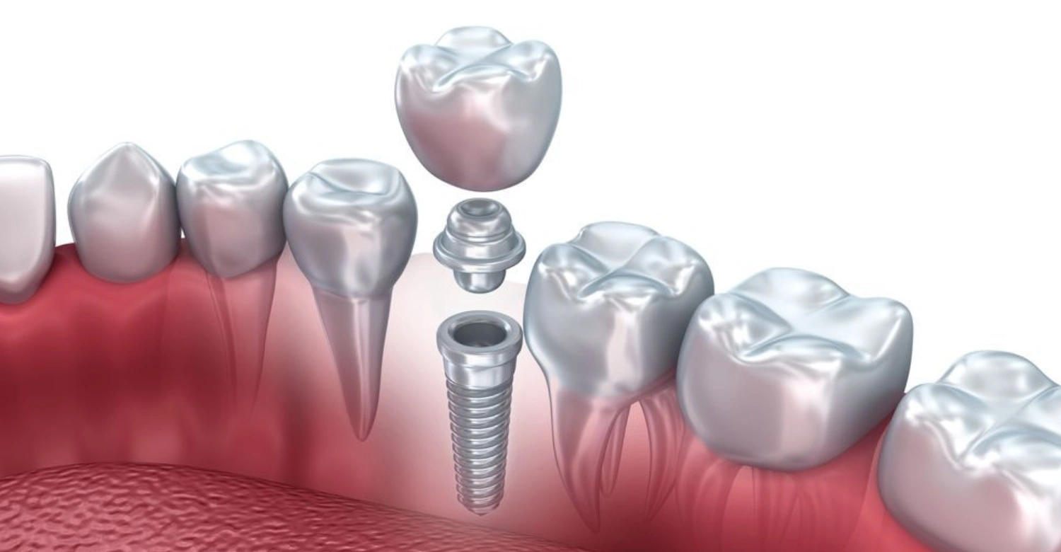 Side Effects of Dental Implant Inblog